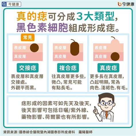 長痣的位置|是痣or皮膚癌？醫「1張圖秒對照」 長這2部位最危險